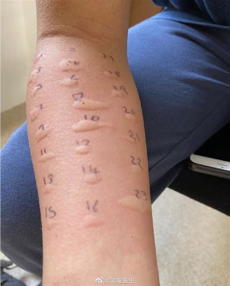 prednisone for skin allergy testing